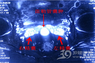 医技微型睛变明 空军总医院泌尿外科精囊镜技术精准诊治血精回顾